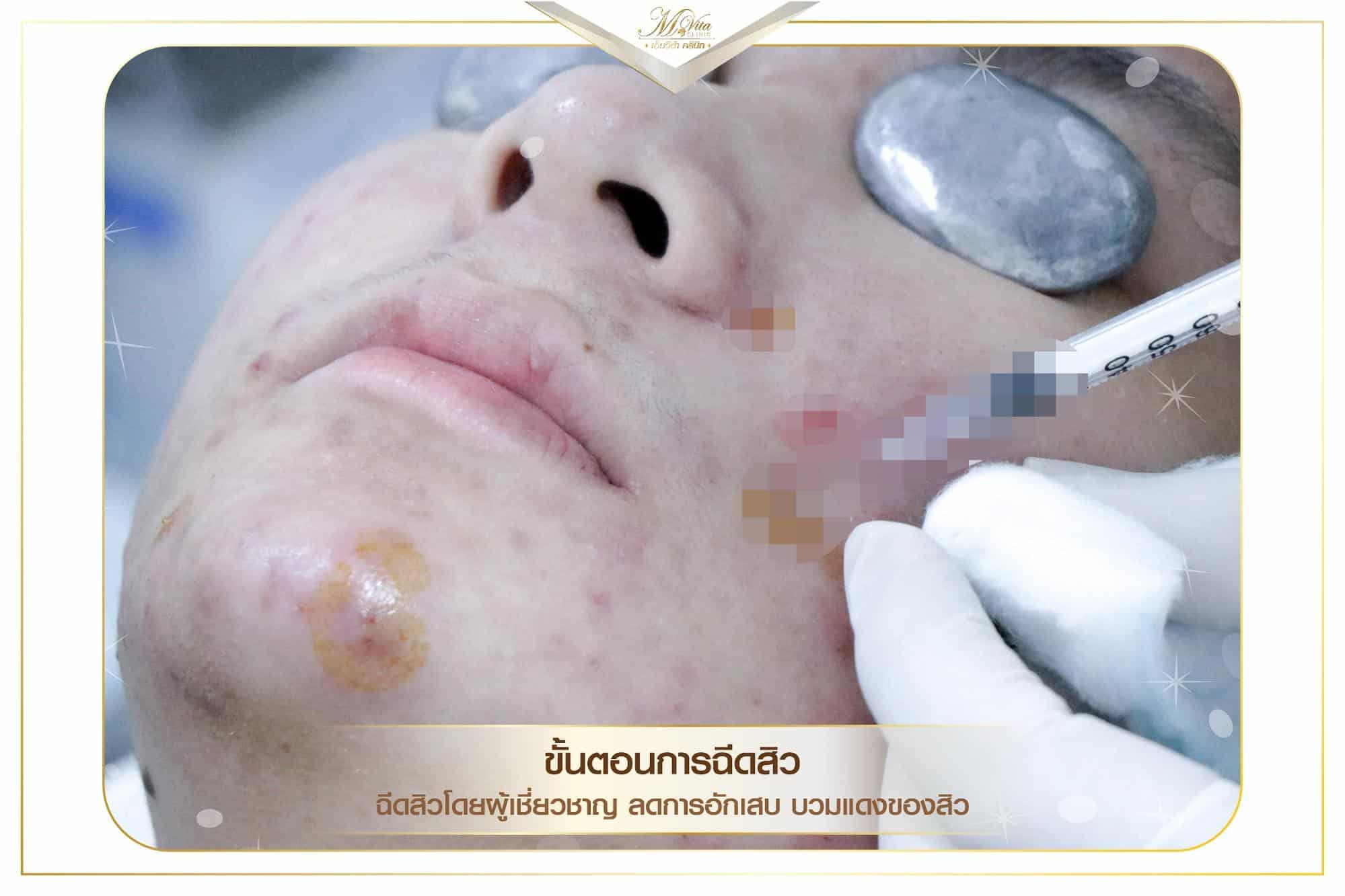 สิวอักเสบเกิดจากอะไร รักษายังไง และมีวิธีดูแลตัวเองเมื่อเป็นสิวอักเสบ พบคำตอบที่นี่ - Mvita Clinic สิวอักเสบเกิดจากอะไร รักษายังไง และมีวิธีดูแลตัวเองเมื่อเป็นสิวอักเสบ พบคำตอบที่นี่ - Mvita Clinic
