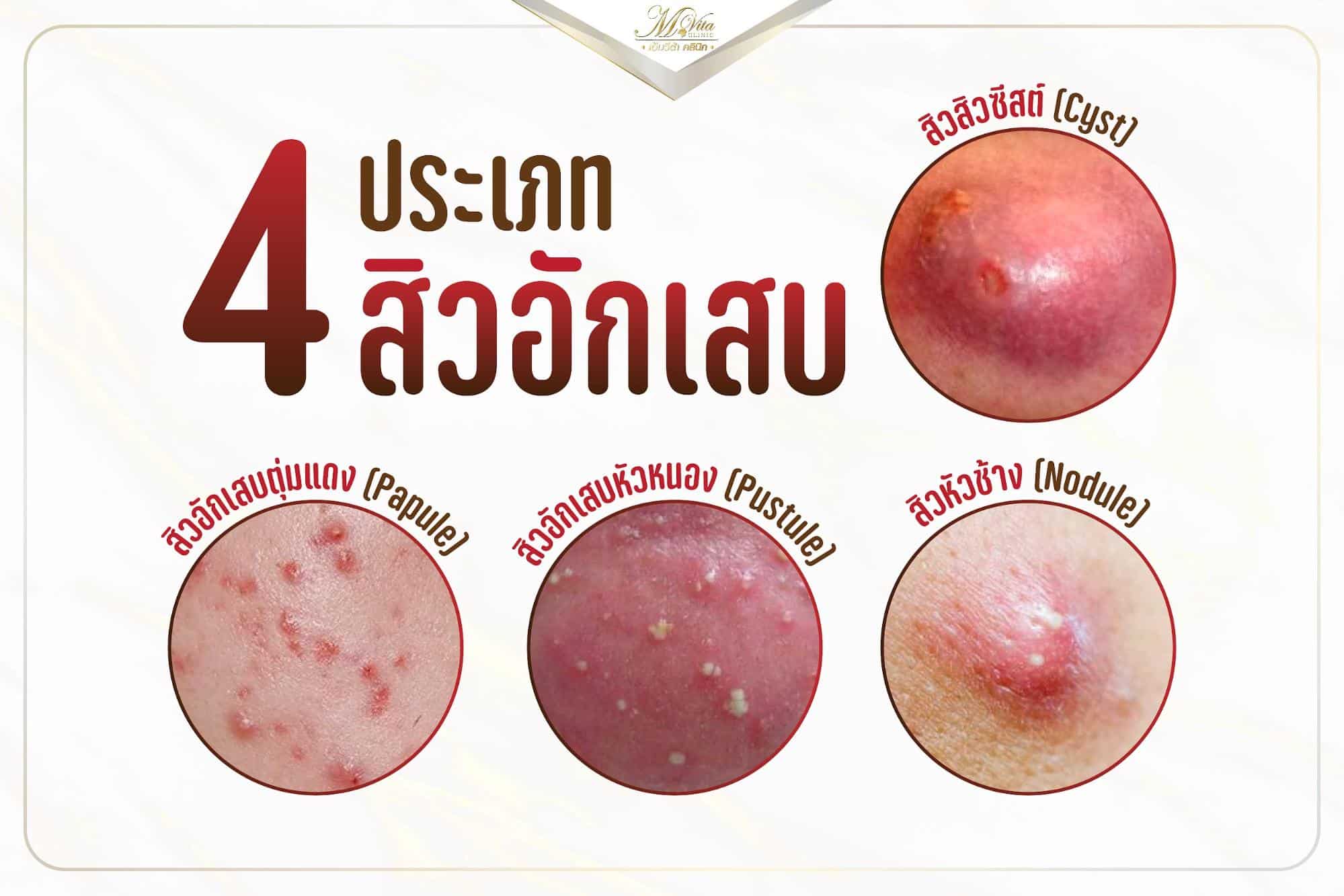 สิวอักเสบเกิดจากอะไร รักษายังไง และมีวิธีดูแลตัวเองเมื่อเป็นสิวอักเสบ พบคำตอบที่นี่ - Mvita Clinic สิวอักเสบเกิดจากอะไร รักษายังไง และมีวิธีดูแลตัวเองเมื่อเป็นสิวอักเสบ พบคำตอบที่นี่ - Mvita Clinic