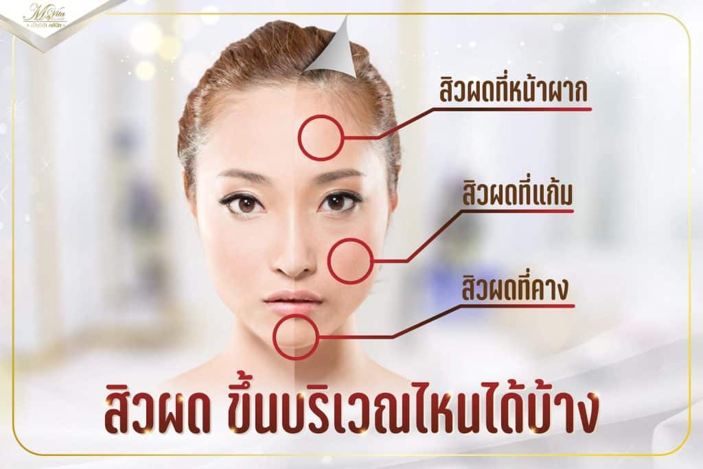 10 วิธี รักษาสิวผด ลดสิวผดบนหน้าแบบเร่งด่วน !! 10 วิธี รักษาสิวผด ลดสิวผดบนหน้าแบบเร่งด่วน !!