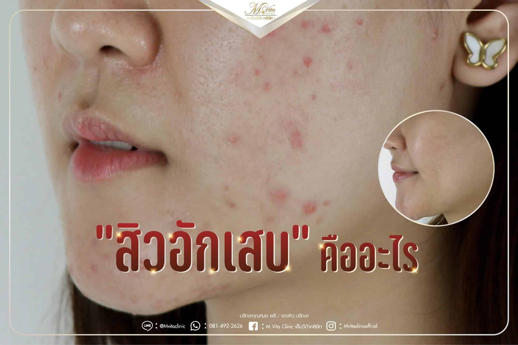 สิวอักเสบเกิดจากอะไร รักษายังไง และมีวิธีดูแลตัวเองเมื่อเป็นสิวอักเสบ พบคำตอบที่นี่ - Mvita Clinic สิวอักเสบเกิดจากอะไร รักษายังไง และมีวิธีดูแลตัวเองเมื่อเป็นสิวอักเสบ พบคำตอบที่นี่ - Mvita Clinic