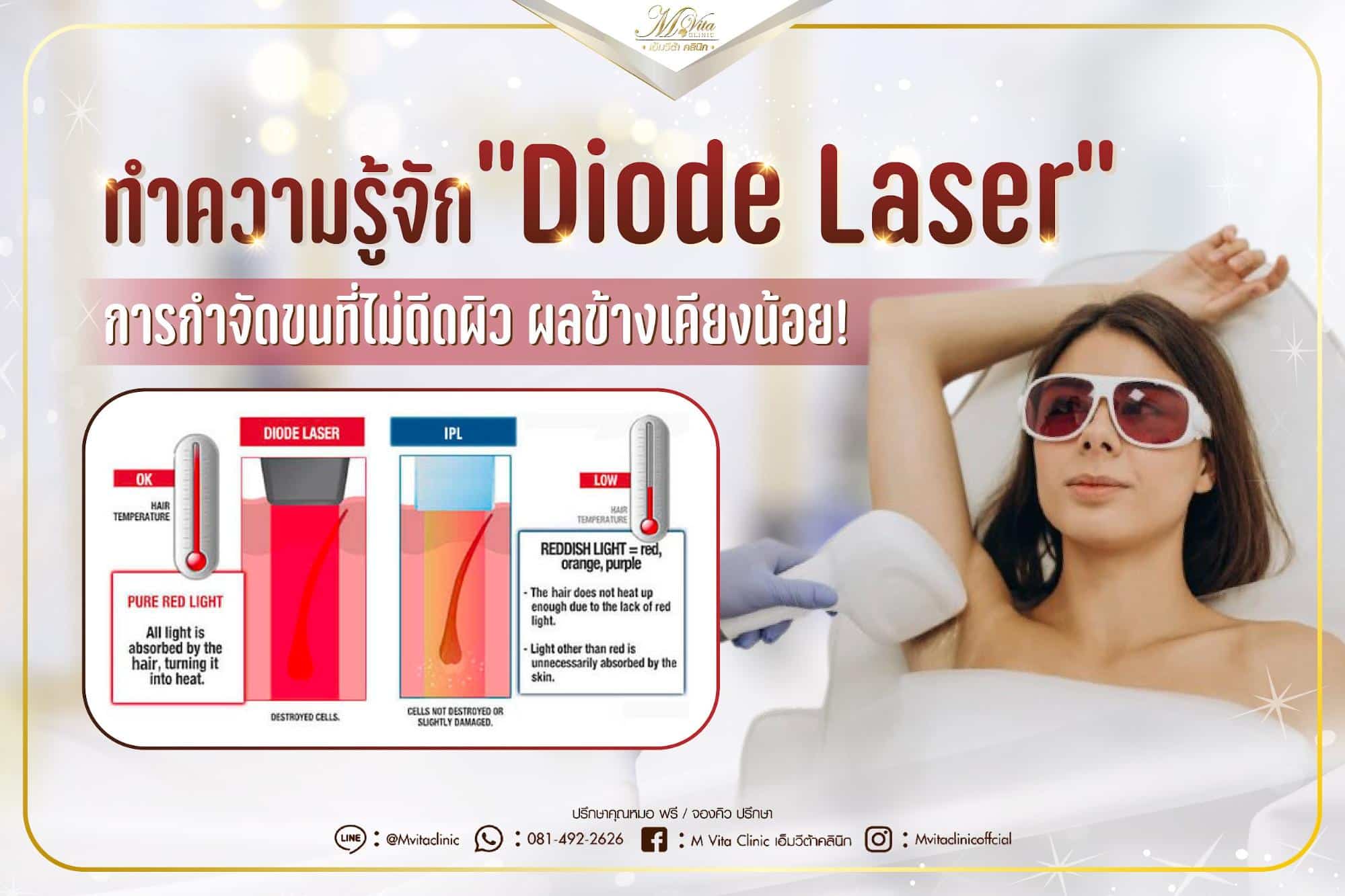 ทำความรู้จัก “Diode Laser” การกำจัดขนที่ไม่ดีดผิว ผลข้างเคียงน้อย!