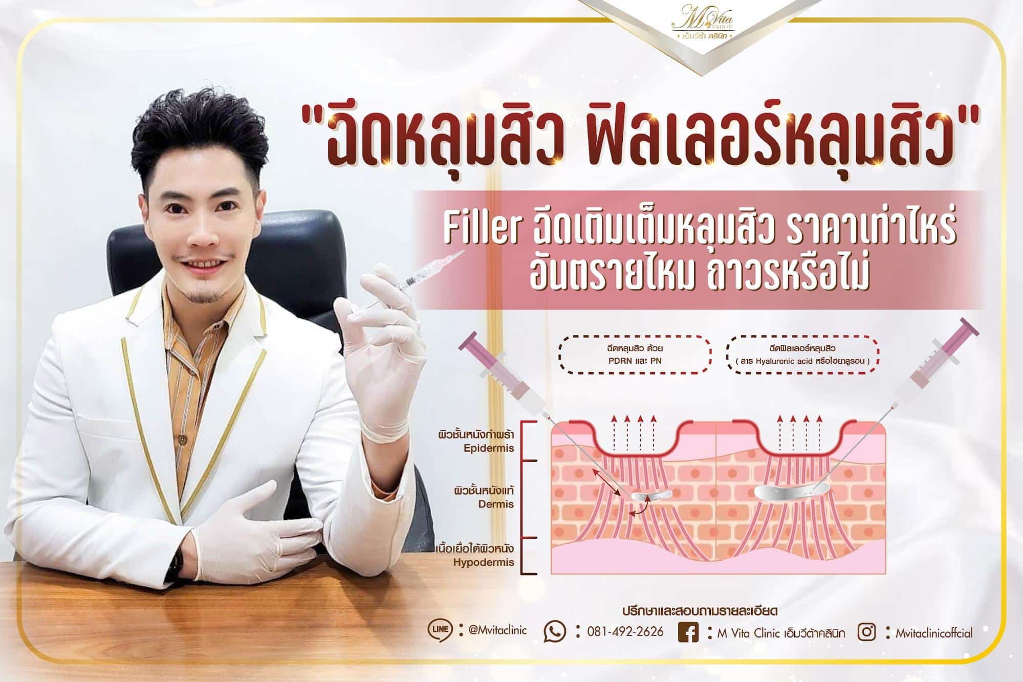 ฉีดฟิลเลอร์หลุมสิว Filler เติมเต็มหลุมสิว ราคาเท่าไหร่? อันตรายไหม?