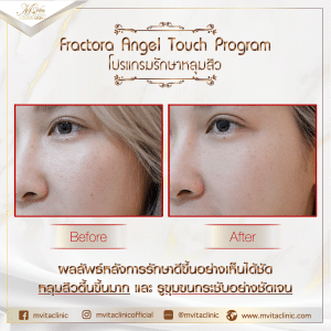 รีวิวรักษาหลุมสิวกับเอ็มวีต้าคลินิก-5