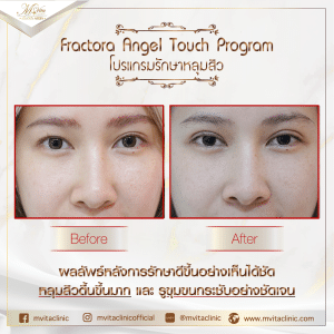 รีวิวรักษาหลุมสิวกับเอ็มวีต้าคลินิก-6