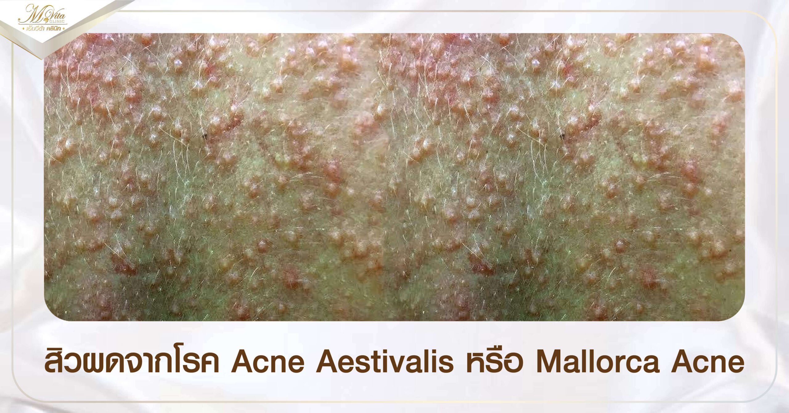 สิวผดจากโรค Acne Aestivalis หรือ Mallorca Acne