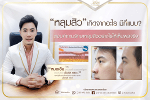 หลุมสิวที่จมูก