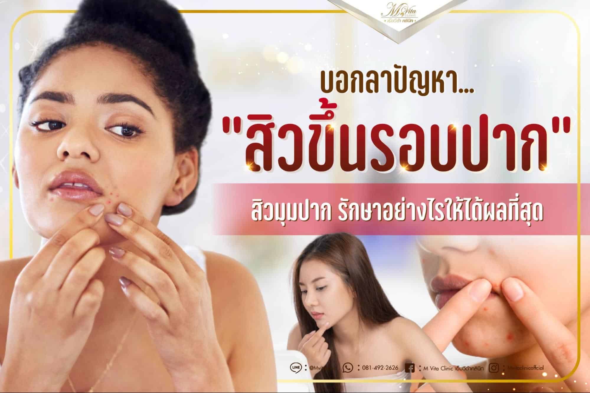 บอกลาปัญหาสิวขึ้นรอบปาก สิวมุมปาก รักษาอย่างไรให้ได้ผลที่สุด บอกลาปัญหาสิวขึ้นรอบปาก สิวมุมปาก รักษาอย่างไรให้ได้ผลที่สุด