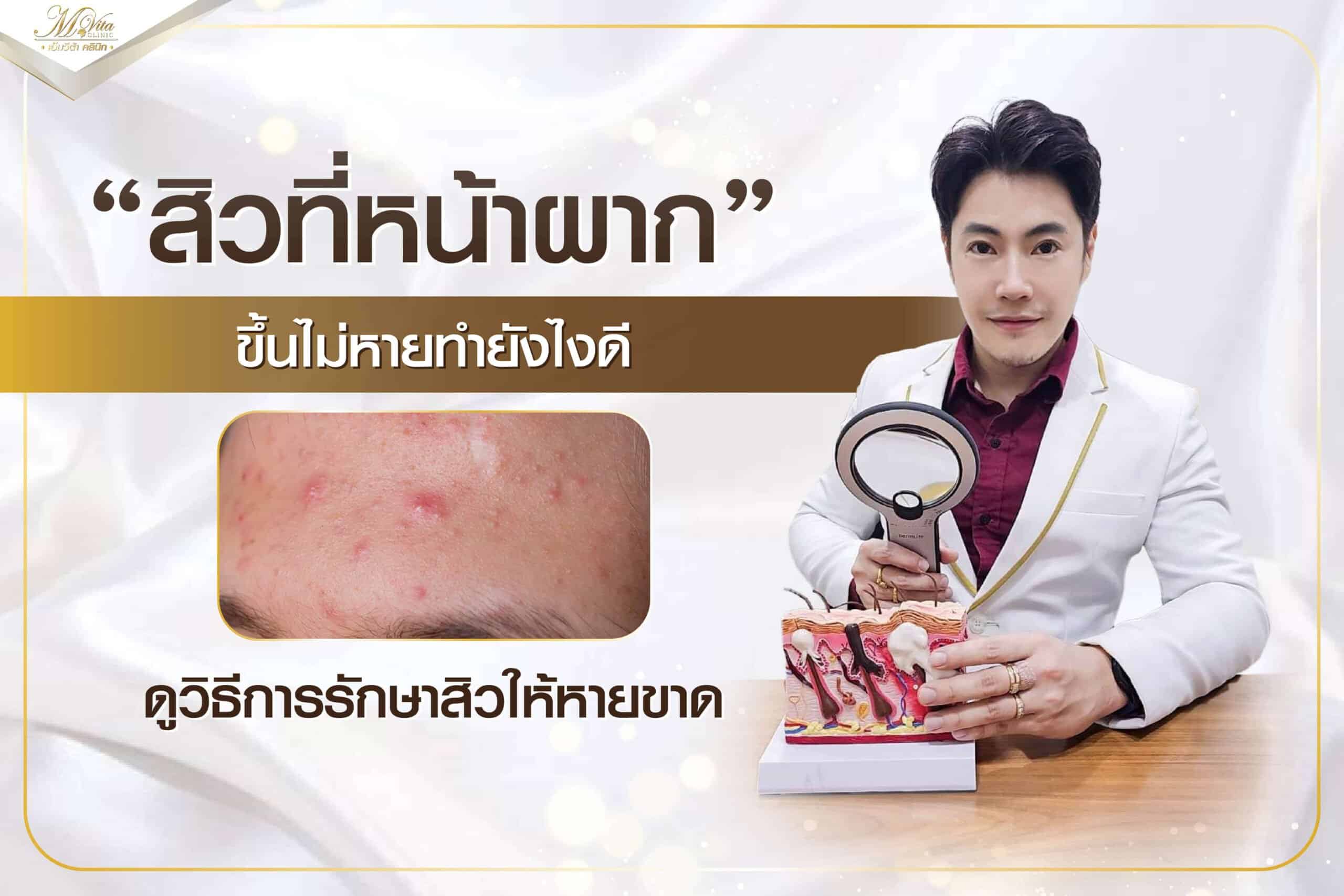 สิวที่หน้าผาก เกิดจากอะไร ขึ้นไม่หายทำยังไงดี วิธีรักษาให้หายขาด