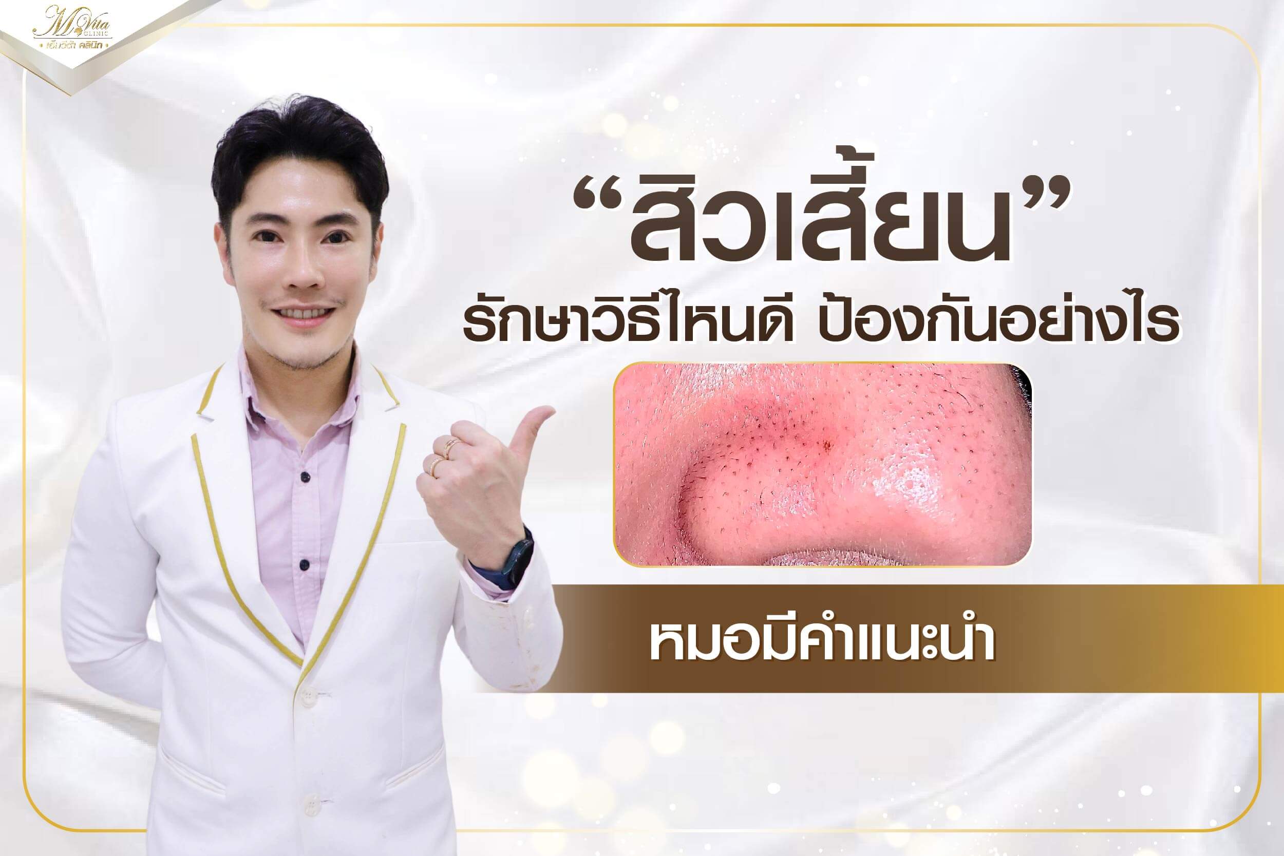 สิวเสี้ยน รักษาวิธีไหนดี ป้องกันอย่างไร หมอมีคำแนะนำ