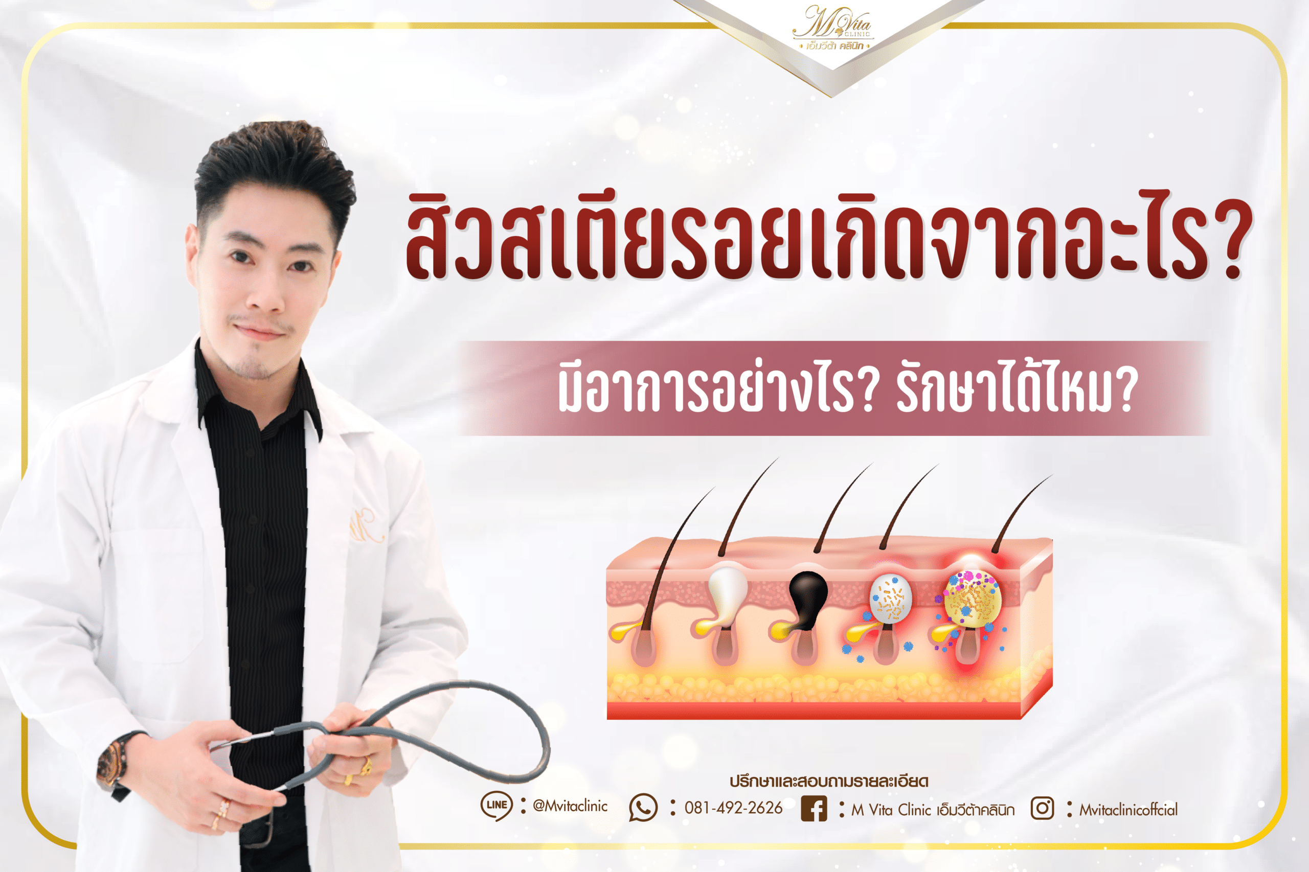 ไขข้อสงสัย สิวสเตียรอยเกิดจากอะไร มีอาการอย่างไร รักษาได้ไหม