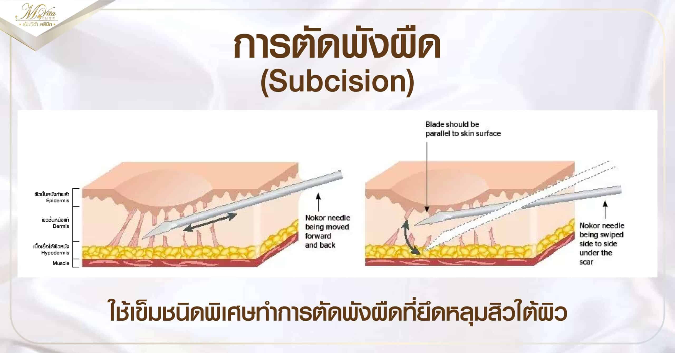 การตัดพังผืด Subcision