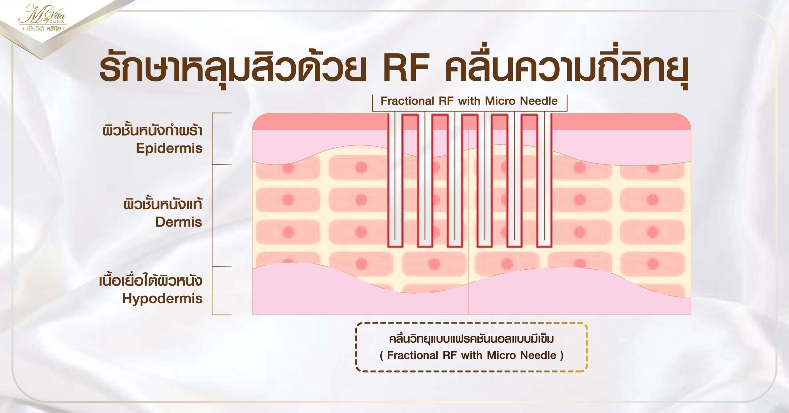 รักษาหลุมสิวด้วย RF คลื่นความถี่วิทยุ
