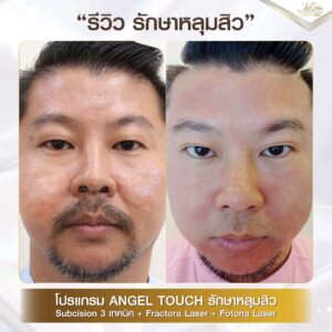 รีวิว รักษาหลุมสิว คุณตี๋