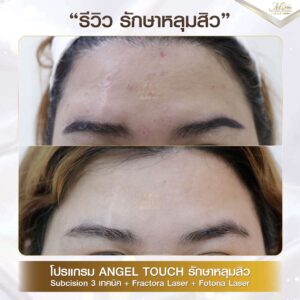 รีวิว รักษาหลุมสิว คุณพรีม