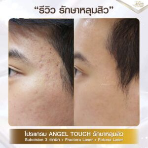 รีวิว รักษาหลุมสิว คุณฮิม