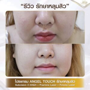 รีวิว หลุมสิว คุณพรีม