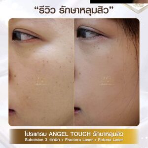 รีวิว หลุมสิว คุณเมย์