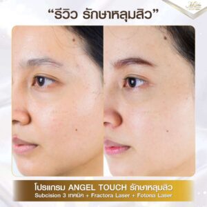 รีวิว เลเซอร์รักษาหลุมสิว คุณไพลิน