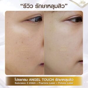 รีวิว เลเซอร์หลุมสิว คุณเมย์