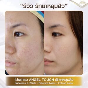 รีวิว เลเซอร์หลุมสิว คุณแอม