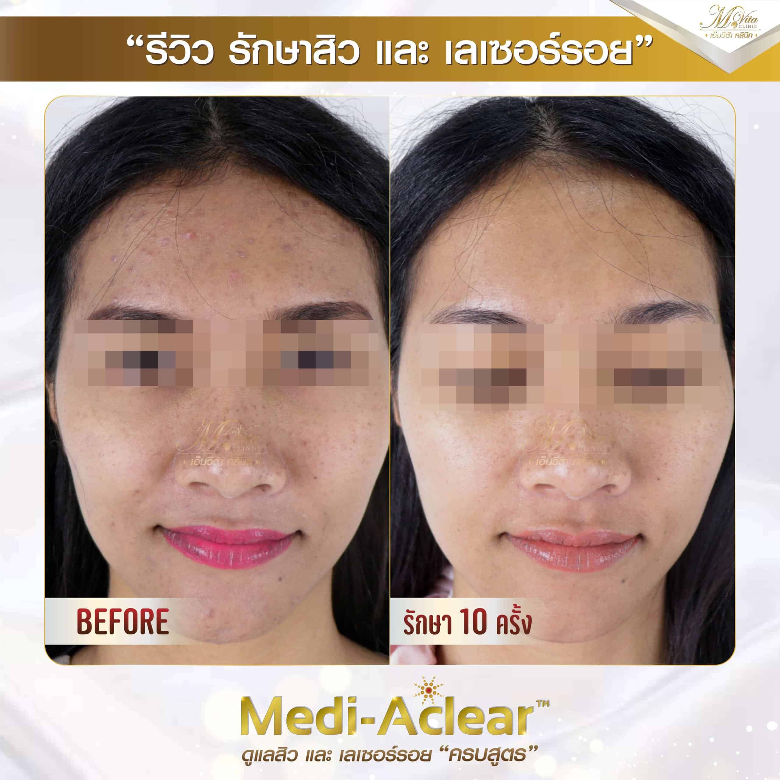 รีวิว รักษาสิวและรอย คุณต๋อม
