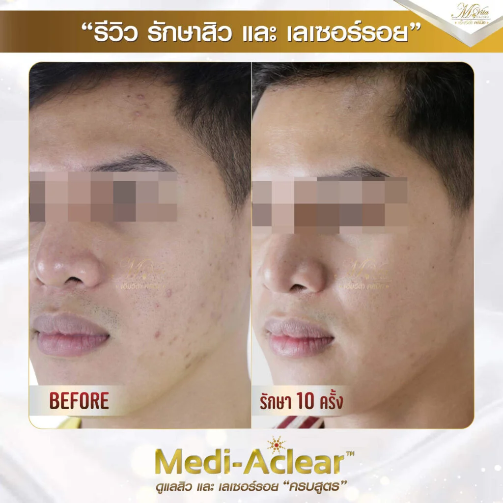 รีวิว รักษาสิวและรอย คุณนัท 1