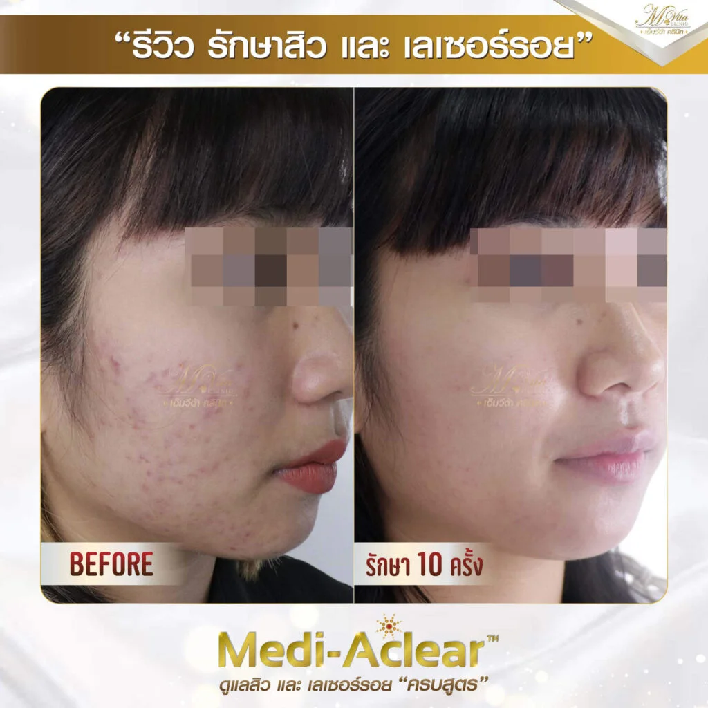 รีวิว รักษาสิวและรอย คุณอาย 1