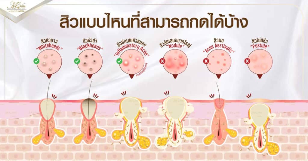 สิวแบบไหนที่สามารถกดได้บ้าง