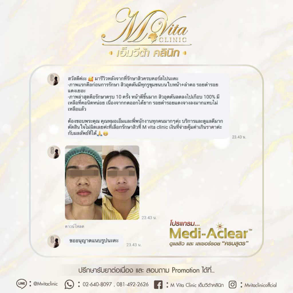 รีวิวรักษาสิว ที่ เอ็มวีต้าคลนิก คุณ Anne Weeraya