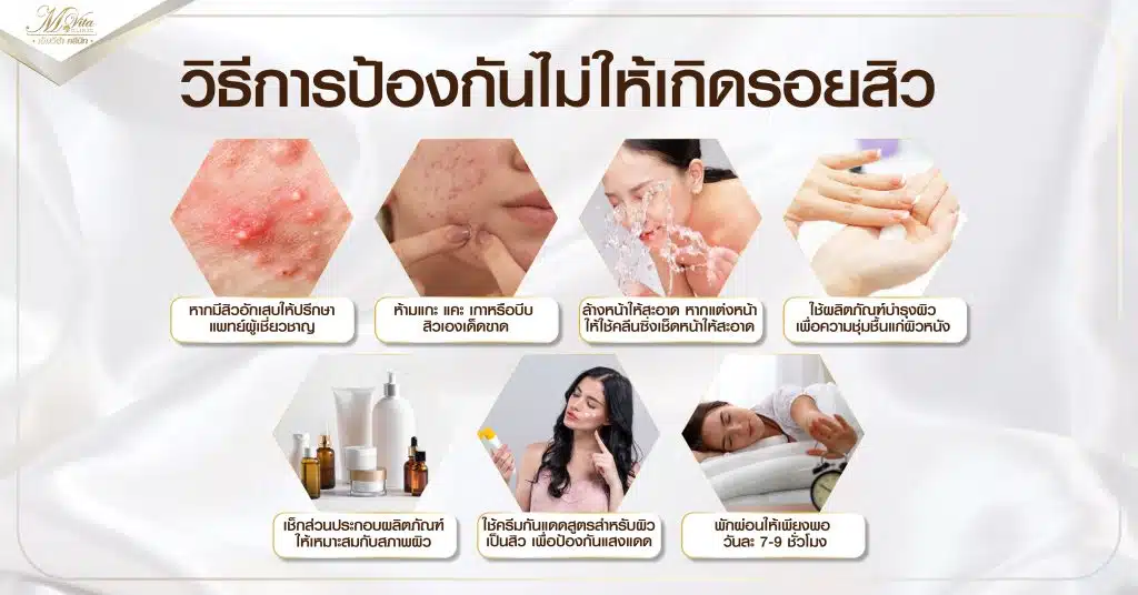 วิธีการป้องกันไม่ให้เกิดรอยสิว