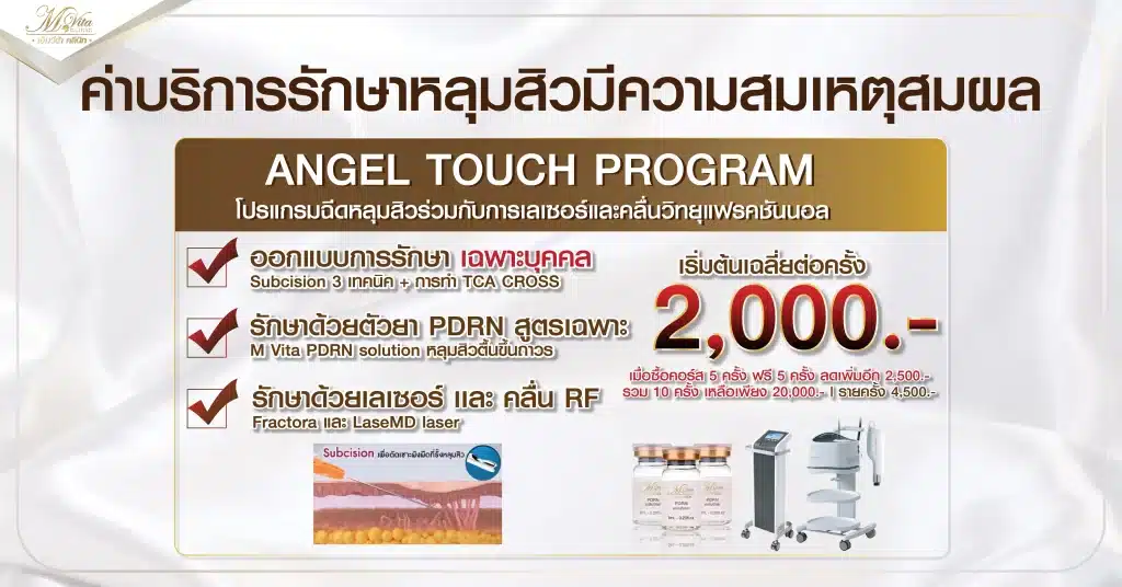 ค่าบริการรักษาหลุมสิวมีความสมเหตุสมผล