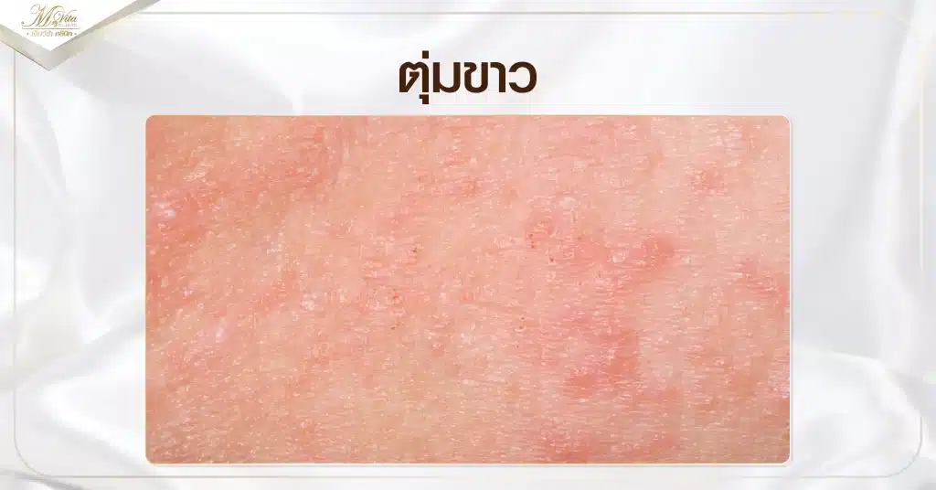ตุ่มขาว