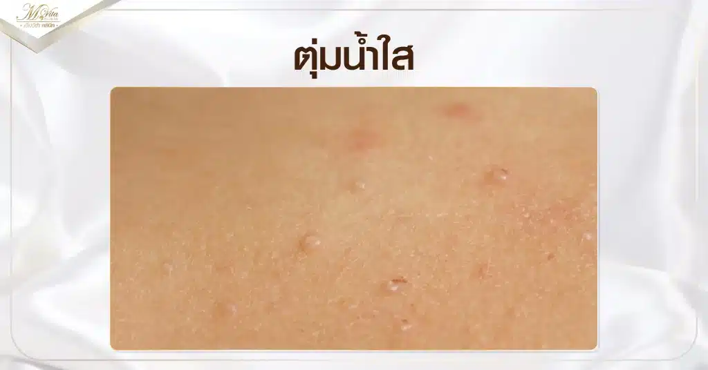 ตุ่มน้ำใส