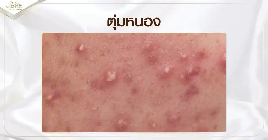 ตุ่มหนอง