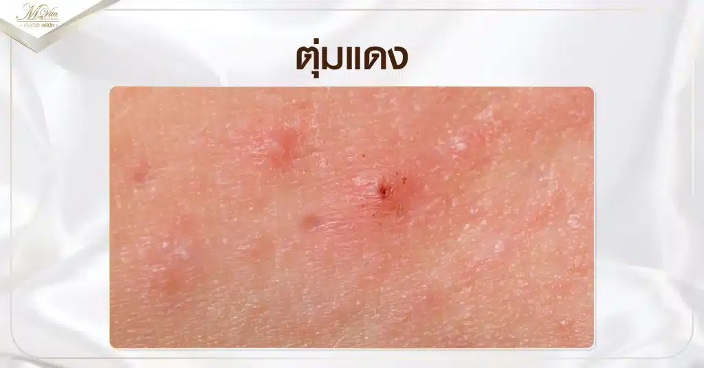 ตุ่มแดง