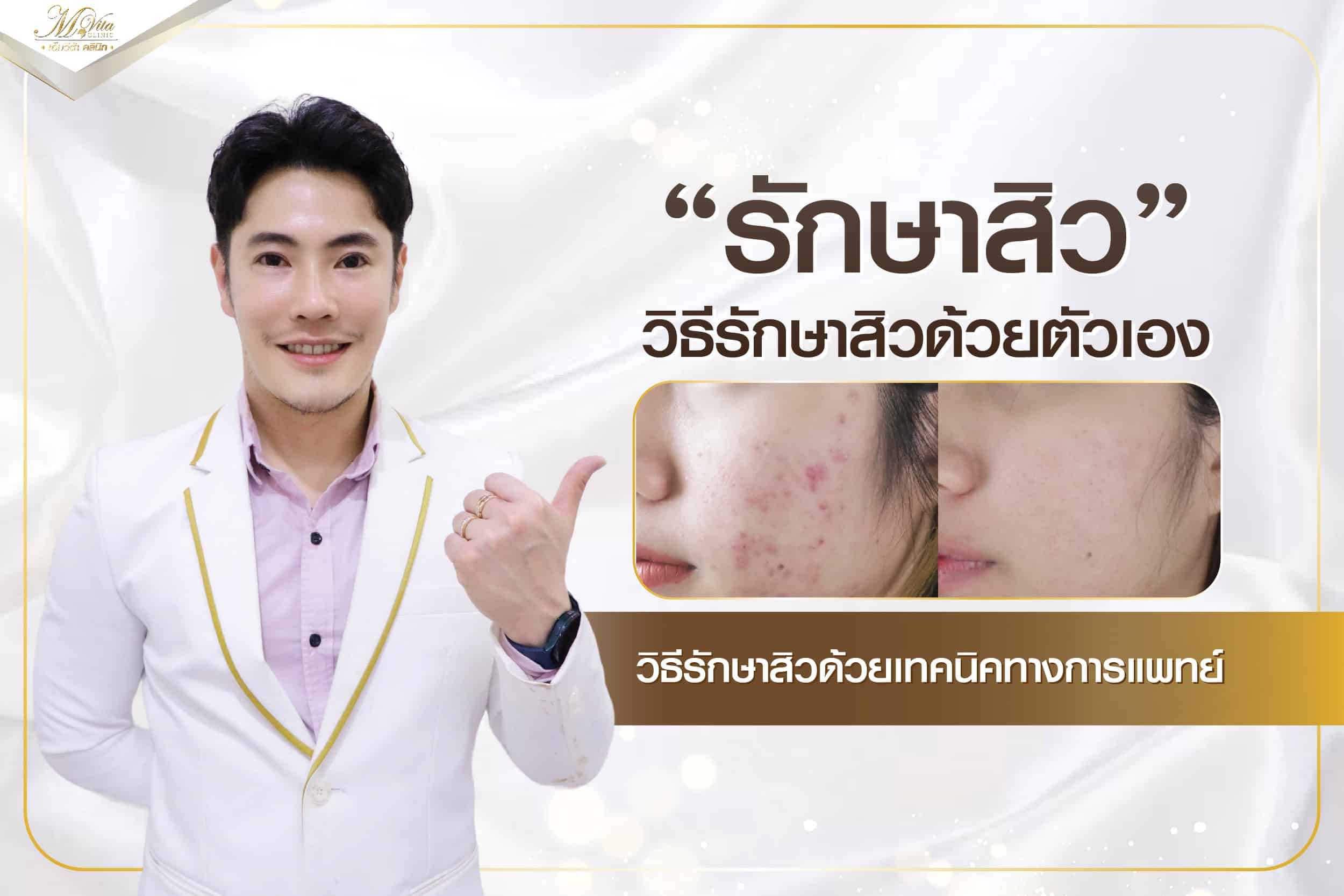 รักษาสิว วิธีรักษาสิวด้วยตัวเอง และ วิธีรักษาสิวที่แพทย์แนะนำ