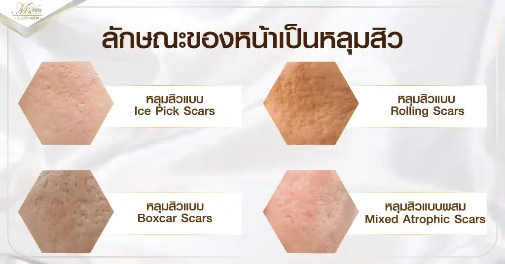 ลักษณะของหน้าเป็นหลุมสิว