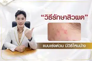 วิธีรักษาสิวผดแบบเร่งด่วน มีวิธีไหนบ้าง