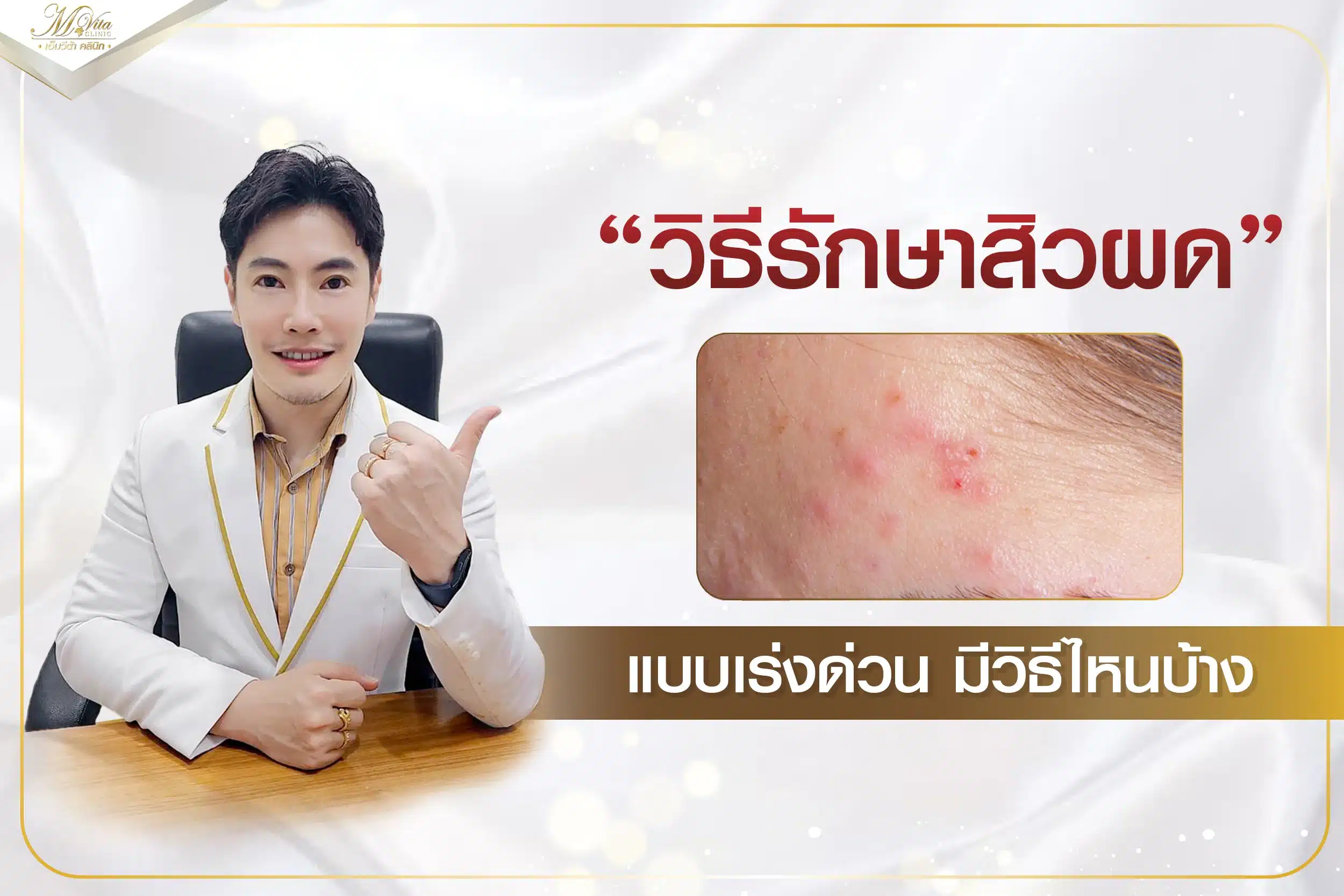 วิธีรักษาสิวผดแบบเร่งด่วน มีวิธีไหนบ้าง