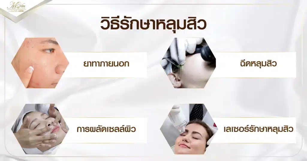 วิธีรักษาหลุมสิว
