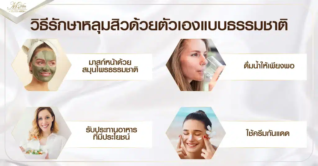 วิธีรักษาหลุมสิวด้วยตัวเองแบบธรรมชาติ