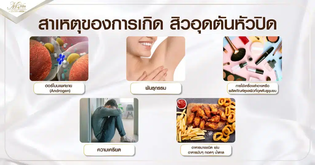สาเหตุของการเกิด สิวอุดตันหัวปิด