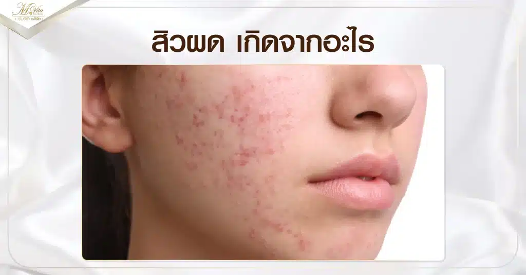 สิวผด เกิดจากอะไร