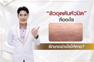 สิวอุดตันหัวปิด คืออะไร รักษาอย่างไรให้หาย
