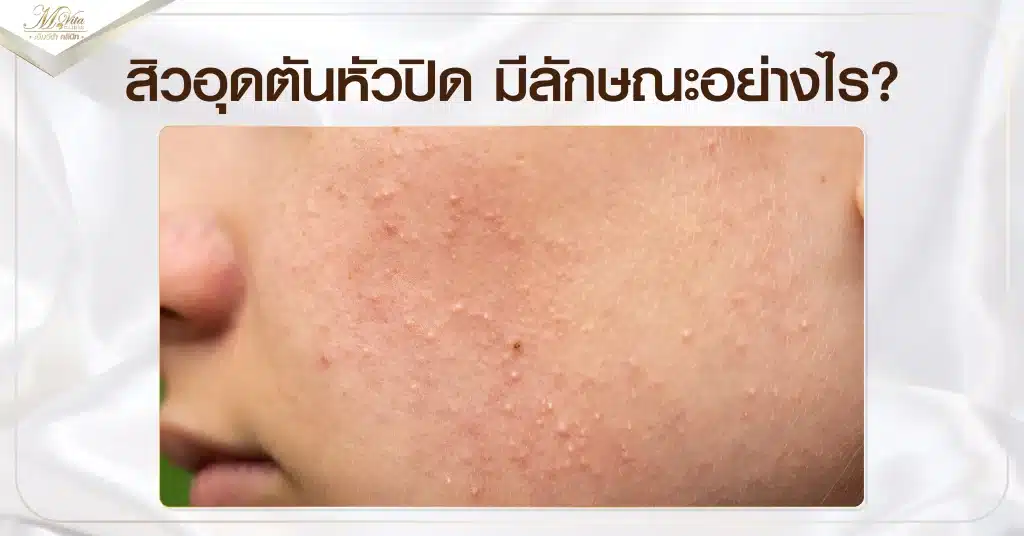สิวอุดตันหัวปิด มีลักษณะอย่างไร