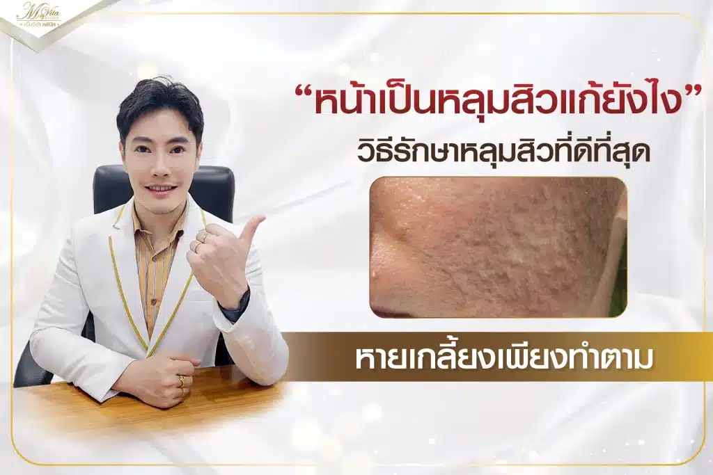 หน้าเป็นหลุมสิวแก้ยังไง วิธีรักษาหลุมสิวที่ดีที่สุด หายเกลี้ยงเพียงทำตาม