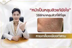 หน้าเป็นหลุมสิวแก้ยังไง วิธีรักษาหลุมสิวที่ดีที่สุด หายเกลี้ยงเพียงทำตาม