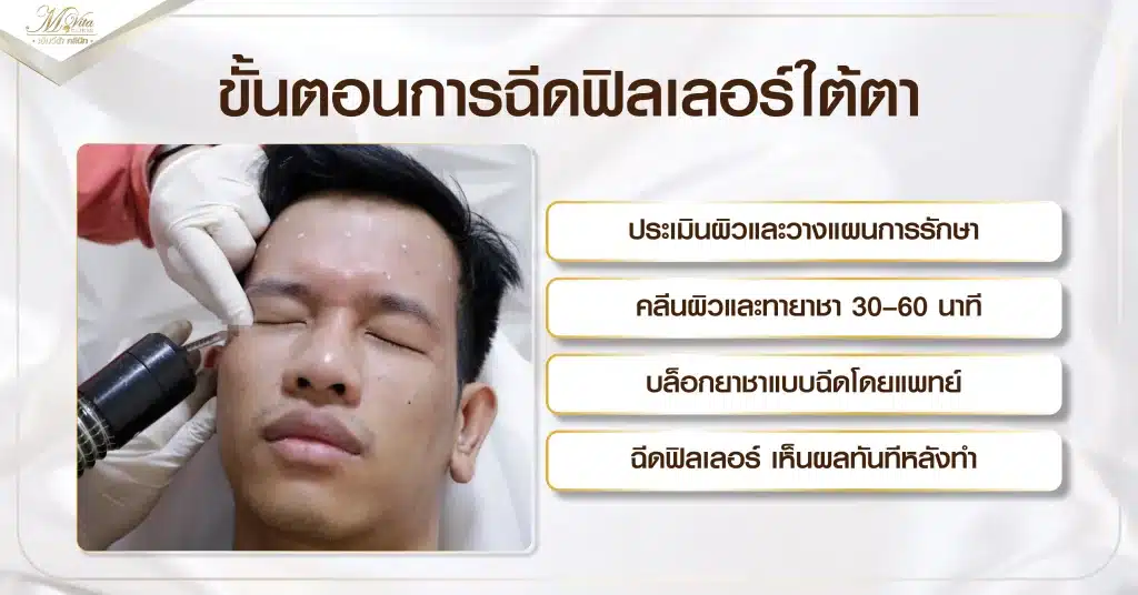 ขั้นตอนการฉีดฟิลเลอร์ใต้ตา