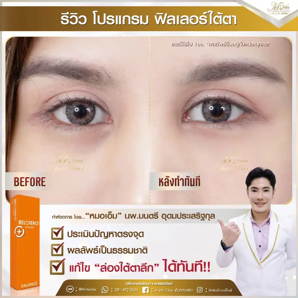 รีวิว ฟิลเลอร์ใต้ตา-01