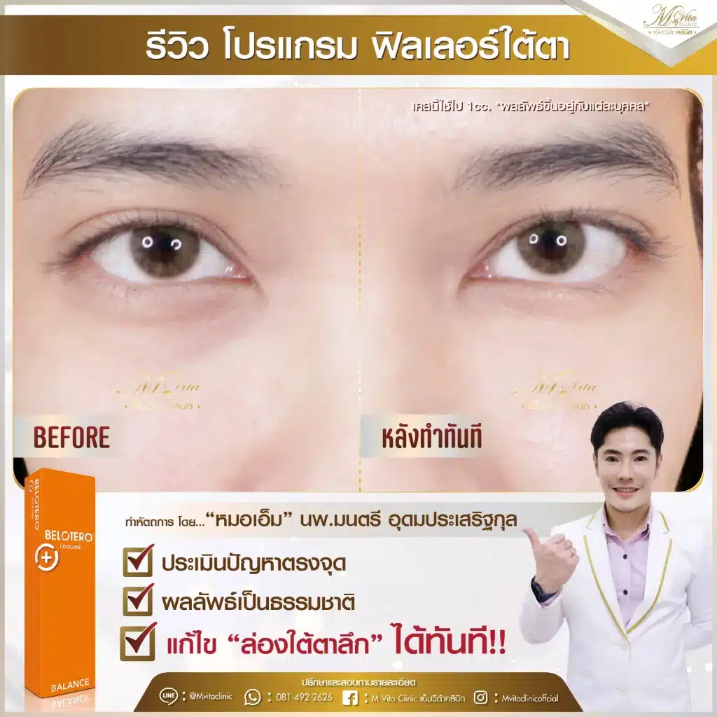 รีวิว ฟิลเลอร์ใต้ตา คุณฟิล์ม-01